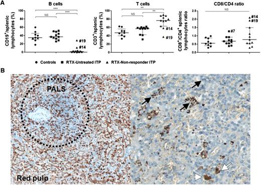 Figure 1. Effect of RTX on splenic lymphocytes and CD8+ localization. (A) Splenic lymphocyte subsets were compared among controls (black circles, n = 9), RTX-untreated ITP patients (black squares, n = 11), and RTX-nonresponder ITP patients (black triangles, n = 12). Data representing the percentage of B cells (CD19+), T cells (CD3+), and the cytotoxic/helper T-cell ratio (CD8+/CD4+) are summarized in dot plots. The horizontal bar represents the median with the interquartile range. P values were derived by Mann-Whitney U test. **P < .01; ***P < .001. NS, nonsignificant. (B) On immunohistochemistry analyses, CD8+ T cells were preferentially located in the red pulp (left panel, anti-CD8, DAB, magnification ×400) and also in periarteriolar lymphoid sheaths (PALS) (left panel, within the dashed circle). Platelets were found in the red pulp (black arrows, right panel, anti-CD61, Ultra-Red, magnification ×800) and into macrophages (white arrows). Representative immunohistochemistry of 1 RTX-nonresponder ITP patient.
