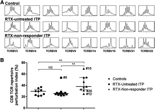 Figure 4. CDR3 size analysis of TCR Vβ transcripts from splenic CD8+ T cells. CD8+ splenic T cells were sorted to perform CDR3 size length analysis. (A) Results of eight Vβ spectratypes among the 24 analyzed are shown for 1 representative subject in each group (control, RTX-untreated, and RTX-nonresponder ITP patients). (B) CD8+ T-cell TCR repertoire perturbation indexes, calculated using ISEApeaks software, are summarized in dot plots in 9 controls (black circles), 11 RTX-untreated patients (black squares), and 9 RTX nonresponders (black triangles). The horizontal bar represents the median with the interquartile range. P values were derived by Mann-Whitney U test. **P < .01. NS, nonsignificant.