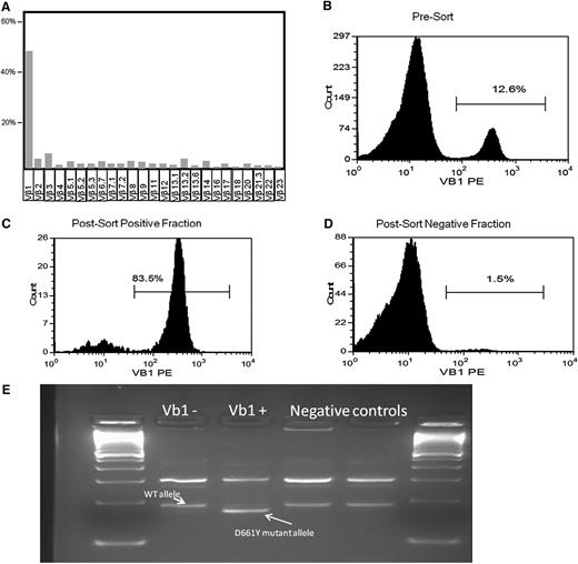 Figure 2. D661Y STAT3 mutation in a hypocellular MDS case. (A-B) Immunodominant Vβ1 fraction before sorting; among the CD8 Vβ repertoire; and blood mononuclear cells. (C-D) Vβ1-positive and -negative fraction after blood mononuclear cell sorting. (E) Presence of the ARMS-PCR D661Y allele only in the Vβ1+ population.
