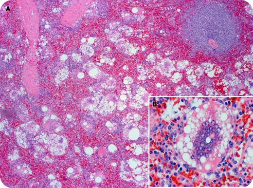 A 59-year-old woman was evaluated for a platelet count of 105 × 109/L, splenomegaly, and associated symptoms of fatigue, early satiety, and nausea. She had history of breast cancer treated with lumpectomy followed by prophylactic bilateral mastectomy and placement of silicone breast implants 25 years earlier. Hemoglobin, white blood cell, liver and renal function, vitamin B12, and folate levels were all within normal ranges. The blood smear showed reduced numbers of morphologically normal platelets; platelet antibody studies were negative. Positron emission tomography/computed tomography imaging showed doubling of the spleen size, with normal consistency and intensity. Bone marrow evaluation was noted for mild hypercellularity and megakaryocyte hyperplasia without clonal populations. Splenectomy revealed an enlarged spleen (710g; normal up to 180) with diffuse lipogranulomatosis, characterized by numerous foreign body giant cells (panel A) and histiocytes with abundant cytoplasmic vacuoles (panel B) occupying the red pulp, consistent with silicone toxicity. A magnetic resonance imaging scan of the breasts revealed bilateral capsular implant ruptures. The patient’s platelet count normalized after splenectomy and her symptoms resolved. The silicone breast implants were subsequently removed and replaced with saline filled implants. / Silicone-mediated toxicity with distant tissue lipogranumolatosis is a feature of both silent and symptomatic implant ruptures. Doctors and patients should be aware of the potential of disseminated silicone driving systemic clinical syndromes. Our patient represents a rare description of silicone-mediated lipogranulomatosis generating symptomatic hypersplenism.