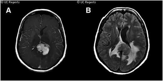 Figure 2. Characteristic radiographic features of PCNSL on magnetic resonance imaging. (A) A T1 axial, postgadolinium image depicts a periventricular contrast-enhancing lesion with near-uniform contrast enhancement, vasogenic edema and mass effect, in displacement of the lateral ventricles. Lesional contrast enhancement using MRI is used for response assessment. (B) A flair signal abnormality demonstrates the extent of vasogenic edema. (Courtesy Soonmee Cha, MD, University of California–San Francisco).