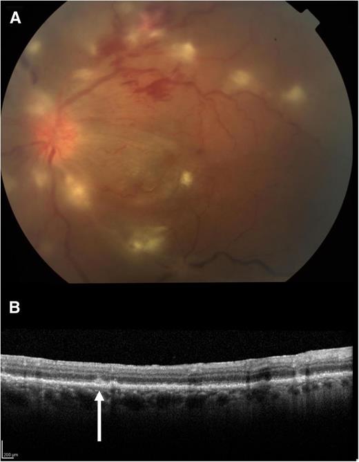 Figure 3. Features of intraocular lymphoma. (A) Slit-lamp evaluation demonstrating advanced intraocular lymphoma with optic disc swelling, vasculitis, and subretinal and retinal infiltrates. (B) Optical coherence tomography demonstrating a nodular hyper-reflective lesion (arrow) at the retinal pigment epithelium and subretinal space. (Courtesty Paul Stewart, MD, University of California–San Francisco).