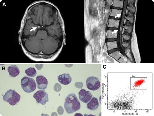 Here, we describe a 52-year-old woman with a history of primary plasma cell leukemia (PCL) who achieved complete remission after the tandem of autologous and nonmyeloablative allogeneic stem cell transplantation (SCT). Nine months after the allogeneic SCT, she presented with oculomotor and trochlear nerve palsy (diplopia, ptosis of the right upper eye lid, and dilated right pupil). Physical examination also revealed mild paresis of the upper arm muscles and the muscles involved in dorsiflexion of the left foot. Contrast-enhanced craniospinal magnetic resonance imaging showed multiple enhancing leptomeningeal nodules (panel A arrows). Cerebrospinal fluid (CSF) examination revealed 321 × 106 leukocytes per L and an elevated total protein level of 2.08 g/L. Microscopic analysis of the CSF showed the presence of very atypical plasma cells (panel B), some of which contain intranuclear inclusions (Dutcher bodies). Immunophenotypic analysis confirmed the presence of plasma cells in the CSF (60% of all nucleated cells). These cells had an aberrant phenotype (CD38+ CD138+ CD19− CD56− CD45+\−; panel C). There was no systemic activity of the primary PCL. / Primary PCL more frequently presents with extramedullary disease when compared with classic multiple myeloma. Therefore, in cases involving neurological deficits, leptomeningeal tumor infiltration should be considered both at diagnosis and at relapse. CSF investigation is mandatory at an early stage to prevent a delay in diagnosis and treatment.