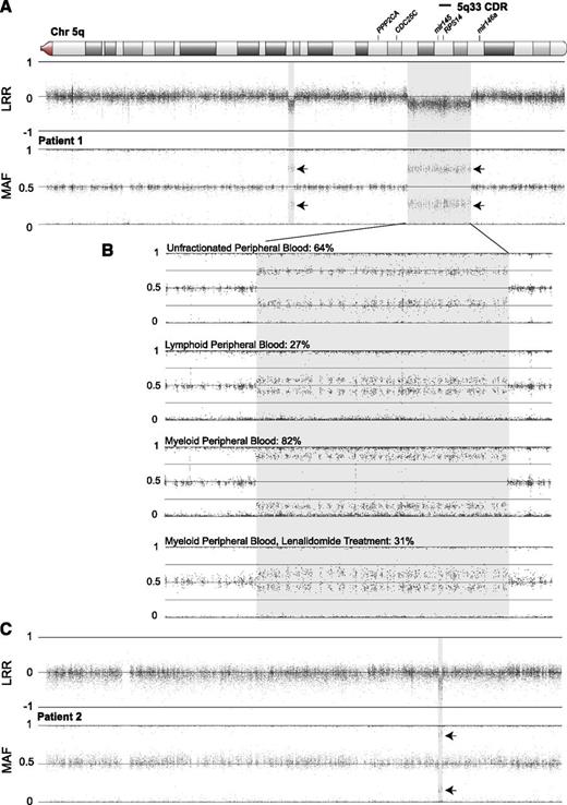 Figure 1. SNP array genotyping demonstrates mosaic deletions of chromosome 5q that overlap the 5q33 CDR in 2 patients. Regions of copy loss (shaded) are indicated by decreased log R signal ratio (LRR). Splitting of the heterozygous minor allele frequencies (MAFs) around the expected 0.5 level in regions of reduced copy number indicates mosaic monosomy/disomy (arrows). The displayed region of chromosome 5q is boxed in the ideogram. (A) Patient 1 has 2 apparently discrete regions of mosaic monosomy in 64% of peripheral blood DNA: a 16.1-Mb deletion extending from chr5:141 108 260 to 157 224 755 (involving PCDH1 to CLINT1) that includes all of the 5q33 CDR, as well as a more centromeric, 1.5-Mb deletion at chr5:110 887 600 to 112 390 739 (involving STARD4 to MCC). Similarities in LRR and MAF signal values at both regions in this and subsequent experiments (Figure 2) suggest the possibility of an intrachromosomal rearrangement joining the 2 regions. (B) Analysis of patient 1 mosaicism indicates a nonuniform distribution of copy loss in circulating cell fractions and improvement with lenalidomide treatment. Mosaicism was estimated to involve 64% of whole-blood DNA at the larger deletion region. Lymphoid-enriched (CD3+ or CD19+) and myeloid-enriched (CD3− and CD19−) DNA prepared from magnetic bead-separated peripheral blood populations showed substantial disparity, with monosomy estimated in only 27% of the lymphoid but 82% of the myeloid population. Similar analysis of the myeloid fraction from blood obtained after 3 months of treatment with lenalidomide showed marked diminution of the monosomic fraction to an estimated 31% of myeloid DNA. Similar changes were also observed in the smaller deletion region (not shown). (C) Patient 2 has an 897-Kb deletion extending from chr5:149 496 080 to 150 393 600 (involving PDGFRB to TNIP1), with monosomy in 77% of the peripheral blood DNA sample. This deletion is approximately half the size and is entirely contained within the current 5q33 CDR. The 5q33 CDR and genes with potential relevance to the 5q syndrome are indicated above the chromosome. Coordinates are expressed relative to National Center for Biotechnology Information Build 36.1.