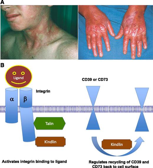 (A) Mutations within all kindlin family members cause pathology in humans and mice. Patients shown here have Kindler syndrome mutations within Kindlin-1. Kindlin-1 is mutated in Kindler syndrome, a skin-blistering disease caused by impaired actin attachment in basal keratinocytes. Kindlin-1 is expressed in epithelial cells. Kindlin-2 is important in early embryogenesis and is expressed in mesenchymal cells. Kindlin-3 is mutated in leukocyte adhesion deficiency, type III, a disease associated with infections, poor wound healing, and cutaneous bleeding. Kindlin-3 is expressed in hematopoietic cells. (B) Kindlin and Talin bind to the cytoplasmic tail of integrin receptors (left) and induce a conformational change in this receptor that permits the binding to its ligand. Kindlin also regulates the recycling of CD39 and CD73 receptors (right), thereby affecting the expression of these receptors on the cell membrane. The images in panel A were taken from Kloeker et al3 (left) and Siegel et al4 (right).
