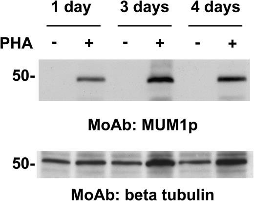 Figure 5. MUM1 expression in normal activated T cells. A 50-kd band of the expected molecular size of the MUM1 protein is seen in lanes (+) corresponding to PHA-stimulated peripheral blood T cells (at days 1, 3, and 4), whereas no band is observed in lanes (–) corresponding to T cells under basal conditions (Western blotting with the MUM1p monoclonal antibody). β-tubulin levels are shown below as control for the amount of the loaded protein.