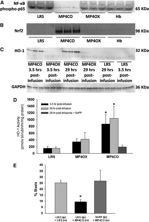 Figure 4. NY1DD sickle mice with implanted DSFCs were infused with LRS, MP4CO, MP4OX, or Hb (8 mL/kg) 24 hours prehypoxia or 30 minutes post-H/R. Livers were removed in all cases after 1 hour of hypoxia and 4 hours of reoxygenation. Thus, livers were removed 29 hours and 3.5 hours postinfusion as indicated. (A) Western blot of liver nuclear NF-ĸB phospho-p65 29 hours postinfusion. (B) Western blot of liver nuclear Nrf2 expression 29 hours postinfusion. (C) Western blot of liver microsomal HO-1 protein expression 3.5 hours and 29 hours postinfusion. (D) Liver microsomal HO activity 3.5 hours and 29 hours postinfusion and after treatment with both MP4CO (29 hours postinfusion) and pretreatment with HO inhibitor SnPP (40 µmols/kg/d × 3 days, IP). N = 4 mice/group. *P < .025. (E) Microvascular stasis after 1 hour of hypoxia and 1 hour of reoxygenation in mice treated with LRS (IP × 3 days) + LRS (IV, 8 mL/kg, 24 hours prehypoxia), LRS (IP × 3 days) + MP4CO (IV, 8 mL/kg, 24 hours prehypoxia), or SnPP (IP, 40 µmols/kg/d × 3 days) + MP4CO (IV, 8 mL/kg, 24 hours prehypoxia). N = 3 mice/group. *P < .025 LRS (IP) + MP4CO (IV) vs LRS (IP) + LRS (IV).