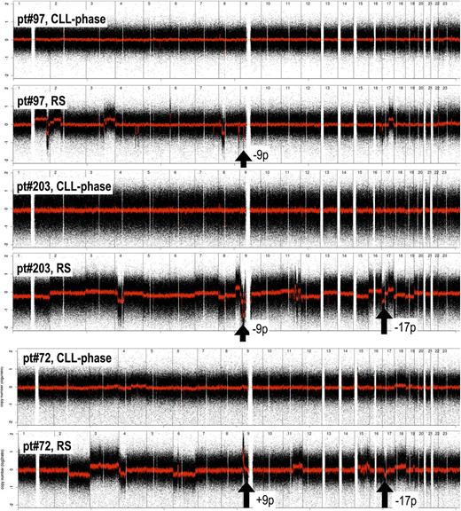 Figure 2. Examples of unbalanced genomic aberration acquired at the transformation in three paired CLL-phase and RS samples. Black arrows highlight losses at 9p (CDKN2A; pt#97, pt#203) and 17p (TP53; pt#203, pt#72) and an amplification at 9p (JAK2; pt#72). Black dots, raw CN values; red line, smoothed CN values. X-axis, genomic mapping; Y-axis, log2 copy-number values.