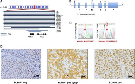 Figure 2. PRDM1 gene is inactivated in ALCL samples. (A) Representation of the aberrations, and their size, affecting the PRDM1 locus (6q21). Blue bars represent loss; light blue bars represent homozygous deletion (hdel). (B) Results of sequencing and mutational analysis of PRDM1 coding exons in 46 ALCL samples (31 ALK− and 15 ALK+ samples) and in 7 ALCL cell lines (5 ALK+ and 1 ALK− cell line and 1 cALCL). Red triangles are new mutations in 2 different ALK− samples. (C) View of the single nucleotide changes in different sequences. (D) Immunohistochemistry results for BLIMP1 staining: BLIMP1 staining was evaluated on TMA obtained from an independent series of ALCL samples. TMA samples were considered negative or positive for BLIMP1 depending on the intensity of the staining. A representative case for each condition, BLIMP1 negative (left panel), BLIMP1 positive only at cytoplasmic level (middle panel), BLIMP1 positive only at a nuclear level (right panel), is reported (magnification, ×40). TMA, tissue microarray.