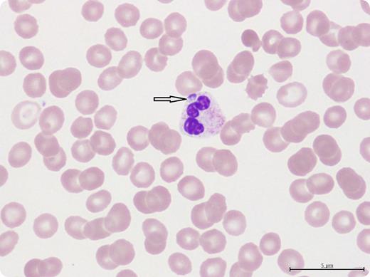 A 63-year-old woman presented with fever, confusion, dysarthria (slurred speech), new-onset thrombocytopenia (26 × 109/L platelets) and mild transaminitis 2 weeks after a tick bite to the left thigh. Physical examination was negative for splenomegaly, rash, or any other focal deficits. A review of the peripheral smear confirmed morulae inside the neutrophils suggestive of a diagnosis of human granulocytic anaplasmosis (HGA). Serologies for Lyme disease, Rocky Mountain spotted fever, ehrliciosis, and anaplasmosis were negative. A reverse-transcription polymerase chain reaction for HGA was positive. Anaplasma antibodies may take 2 to 3 weeks to become positive and thus have low negative predictive value in acute presentations. The patient responded well to intravenous doxycycline with recovery of platelets (>200 × 109/L), resolution of fever, transaminitis, and confusion. At the time of discharge, she still had dysarthria as an unusual isolated neurological manifestation of HGA not reported before. Computed tomography scan and magnetic resonance imaging of the brain did not show any lesions that could explain dysarthria. / Review of peripheral smear in patients with thrombocytopenia and history of tick bite should focus on inclusion bodies in granulocytes and monocytes.