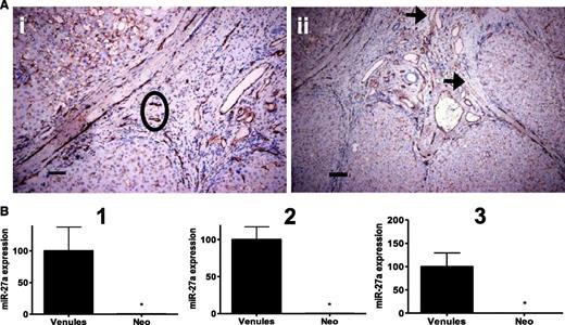 Figure 4. Regulation of miR-27a in human disease. Human liver tissue from 3 patients with cirrhosis was stained for CD31. (A) Neo-angiogenic vessels (neovessels) in the fibrous septa; (ii) the black circle and venules as indicated with black arrows were captured by LCM. The scale bars indicate (i) 15 µm and (ii) 30 µm. (B) RNA was isolated from ECs in either venules or neovessels (Neo) from three patients (1-3). Expression levels of miR-27a were quantified by qRT-PCR and normalized to miR-520d*. Data represent the mean of quadruplicate qRT-PCR reactions ± SEM. *P < .05 Venules vs Neo.