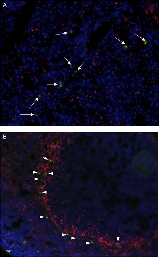 Figure 5. Platelets colocalize with macrophages in liver and spleen of VWD type 2B mice. Platelets were isolated from wt-mVWF–expressing or p.V1316M-mVWF–expressing mice, stained with CMTMR cell tracker and reinfused (8 × 107 platelets per mouse) in wt-mVWF–expressing or p.V1316M-mVWF–expressing mice, respectively. Two hours after platelet infusion, liver and spleen were isolated to prepare cryosections. Macrophage subpopulations were identified via immunofluorescence: CD68-positive resident macrophages (Kupffer cells) in liver (A) and CD169-positive marginal metallophilic macrophages in spleen (B). Macrophages are in red, CMTMR-fluorescent platelets are in green, and nuclei are in blue. Original magnification is ×20.