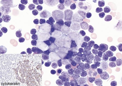 A 79-year-old woman presented with new-onset weight loss, bilateral axillary lymphadenopathy (LAD), and a chest wall mass. A complete blood count showed a leukocytosis of 87 600/μL with 99% lymphocytes. A review of the peripheral blood smear and flow cytometry (data not shown) showed chronic lymphocytic leukemia (CLL). / Due to B symptoms, LAD, and a chest wall mass, a Richter transformation (RT) of the CLL was highly suspected. The bone marrow aspirate revealed extensive marrow involvement by CLL. In addition, there were many large cells with oval nuclear contours and open chromatin. These cells were arranged singly or in small cohesive clusters. / While RT was within the differential diagnosis, a metastatic carcinoma was preferred. The bone marrow biopsy specimen (data not shown) showed that in the background of CLL was the focal infiltrate of a sheet of cohesive pan-cytokeratin–positive large cells (see insert) that were negative for B-cell antigens, including PAX-5. The excisional chest wall and axillary lymph node biopsy specimens showed a Merkel cell carcinoma (MCC) and a metastatic MCC, respectively. / Approximately 94% of MCCs are positive for PAX-5, which can lead to an erroneous diagnosis of RT if only PAX-5 immunohistochemistry is chosen. However, the MCC in this case was negative for PAX-5.