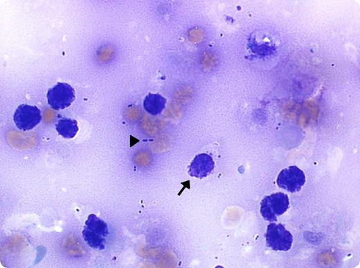 A 71-year-old man with a medical history of gastric adenocarcinoma treated by surgery 2 years ago was hospitalized in the intensive care unit for septic shock due to Streptococcus gallolyticus. Before septic shock, he presented intense and unexplained back and pelvis pain. Blood cell count findings were hemoglobin 8.9 g/dL, platelets 36 × 109/L, and white blood cells 9.87 × 109/L with erythromyelemia. Other biological results showed elevated lactate dehydrogenase and alkaline phosphatase. Sternal and iliac bone marrow aspiration revealed dark smears after May-Grünwald Giemsa (MGG) coloration. Microscopic evaluation showed disintegrated cells, pycnotic nuclei (arrow), and bacteria (arrowhead) surrounded by a background of amorphous extracellular eosinophilic material. Bone marrow culture found S gallolyticus. Pleural effusion analysis revealed metastatic cells of gastric origin. The diagnosis of bone marrow necrosis (associated with sepsis and possible medullary metastasis of gastric adenocarcinoma) and secondary bone marrow infection due to septicemia was retained. No specific treatment was undertaken excluding antibiotherapy. The patient died 48 hours later. / Bone marrow necrosis is a rare disorder mainly associated with acute leukemia and solid cancer (most often gastric adenocarcinoma). Unexplained physiopathology and poor prognosis is the rule. Observation of bacteria on bone marrow smears after MGG coloration is exceptional.