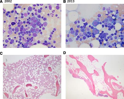 Figure 1. Bone marrow aspirate (A-B) and biopsy sections (C-D) in 2002 and in 2013. (A,C) Bone marrow in 2002 showing erythroid hyperplasia (myeloid to erythroid ratio 1:2), increased numbers of erythroblasts, 50% to 60% cellularity on core biopsy, and absent stainable iron. (B,D) Bone marrow in 2013 showing decreased myeloid precursors with erythroid hyperplasia, marked hypocellularity (10%), reduced megakaryocytes, and iron stain markedly increased.