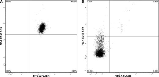 Figure 2. Flow cytometry of peripheral blood. (A) Normal expression. (B) Showing 97.8% granulocytes lacking staining for CD55, CD59, and fluorescein-labeled proaerolysin.
