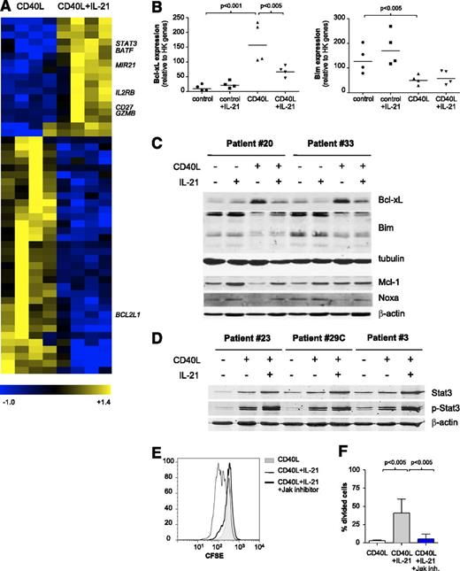 Figure 3. IL-21 alters the antiapoptotic profile induced by CD40L by downregulating Bcl-XL and induces proliferation through Jak-STAT3. (A) Gene expression analysis of sorted CD19+ CD5+ CLL cells, cultured with CD40L-expressing fibroblasts in the absence or presence of IL-21 for 16 hours. Heatmap of 51 differentially expressed genes (ANOVA P < .01; fold change >3; minimum present calls >3; minimum highest expression >200), depicting results for paired samples from 4 patients (samples 2, 5B, 11, 30). (B) The RNA samples from panel A were analyzed for expression of different apoptotic mediators by MLPA. Results are shown for relevant genes as relative expression to HK genes (mean ± SD; n = 4). (C-D) CLL cells cultured as in panel A were analyzed after 72 hours by western blot for the indicated BCl-2 family members. Tubulin and β-actin were used as loading controls. (E) CFSE-stained CLL cells were cultured with CD40L-expressing fibroblasts alone, together with IL-21 (25 ng/mL) or IL-21 plus an inhibitor of Jak kinases (Ruxolitinib, 1 μg/mL) for 5 days. Representative histograms from sample 23 are shown. (F) CLL cells were cultured as in panel E. The percentage of divided cells is depicted as mean ± SD, for samples 16B, 23, and 29C.
