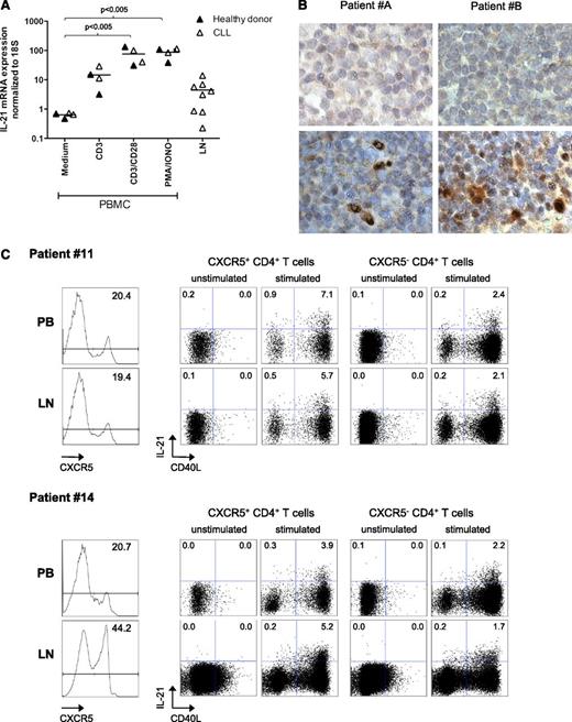 Figure 6. IL-21 expression in lymph nodes from CLL patients. (A) IL-21 expression was studied by qRT-PCR in RNA from PBMCs from 2 healthy donors and 2 CLL patients (samples 6A, 8), after activation with αCD3 or αCD28 antibodies or PMA + ionomycin, or in total frozen LN samples from CLL patients (samples 34 to 40). (B) IL-21 expression was analyzed in 2 paraffin-embedded CLL LN samples by IHC. Upper panels show nonspecific staining with control antibodies; lower panels show results with anti-IL-21 antibodies. Original magnification ×40, further digital magnification ×4. (C) Matched samples of PB and LN from 2 CLL patients (samples 11 and 14) were stimulated as indicated in the “Methods” section for 4 hours. They were then stained for expression of CD3, CD4, CXCR5, CD40L, and IL-21. Results depict the histograms for CXCR5 expression (unstimulated samples, left panels) and the expression of IL-21 and CD40L by CXCR5+ and CXCR5− CD3+ CD4+ cells for PB (upper) and LN (lower) samples.