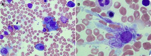 A 56-year-old woman with a history of dyslipidemia and hepatic steatosis presented with weight loss and progressive proteinuria. The presenting blood count was normal: white blood cells, 10.9 × 109/L; hemoglobin, 15.5 g/dL; platelet count, 236 × 109/L. No significant rouleaux formations were present on the peripheral blood smear. Calcium (9.28 mg/dL), blood urea nitrogen/creatinine (15/0.78 mg/dL), and protein/albumin (6.9/4.2 g/dL) were normal. The squelettal survey showed no lytic bone lesions. Serum protein electrophoresis and immunofixation electrophoresis showed no monoclonal component. Serum-free light chain assay revealed high levels of κ light chains (890 mg/L) and normal levels of λ light chains (9.8); κ-λ ratio was 90.8. Urine protein electrophoresis showed free κ-type Bence-Jones proteinuria (1.64 g/L). A bone marrow aspiration revealed a normal blast count (3%) and no dysplasia. Plasma cells constituted 20% of nucleated cells. The figure shows plasma cells demonstrating many Auer rod-like crystal inclusions in the cytoplasm (panel A) and a histiocyte engulfing numerous Auer rod-like inclusions (panel B). Fluorescence in situ hybridization studies revealed monosomy 13 and possibly monosomy 14 or deletion of IGH sequence. The patient was diagnosed with κ light chain multiple myeloma and was started on a bortezomib-based regimen. / To the best of our knowledge, this phenomenon is rare and is always associated with a κ-type paraprotein.