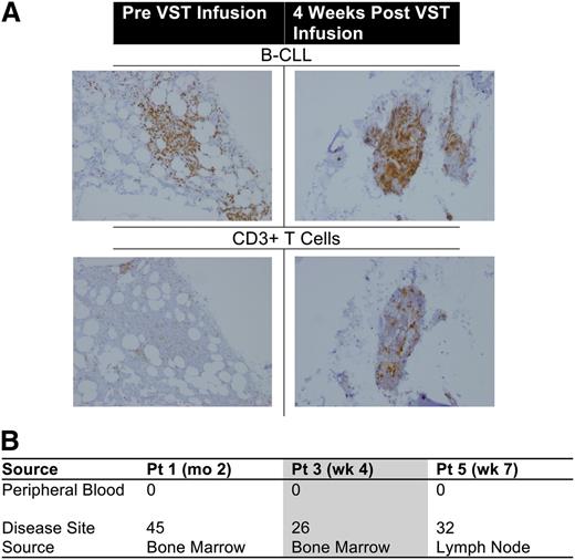 Figure 4. In vivo trafficking of CD19.CAR-VSTs. (A) CD19.CAR-VSTs accumulate at the sites of disease. Immunohistochemistry stain of B-CLL cells (top row) and CD3+ T cells (bottom row) from patient 3. (B) Summary table documenting the presence of detectable CD19.CAR-VSTs at the sites of disease as assessed by Q-PCR compared with concomitant PB samples measured as copies per 1000 ng of DNA.