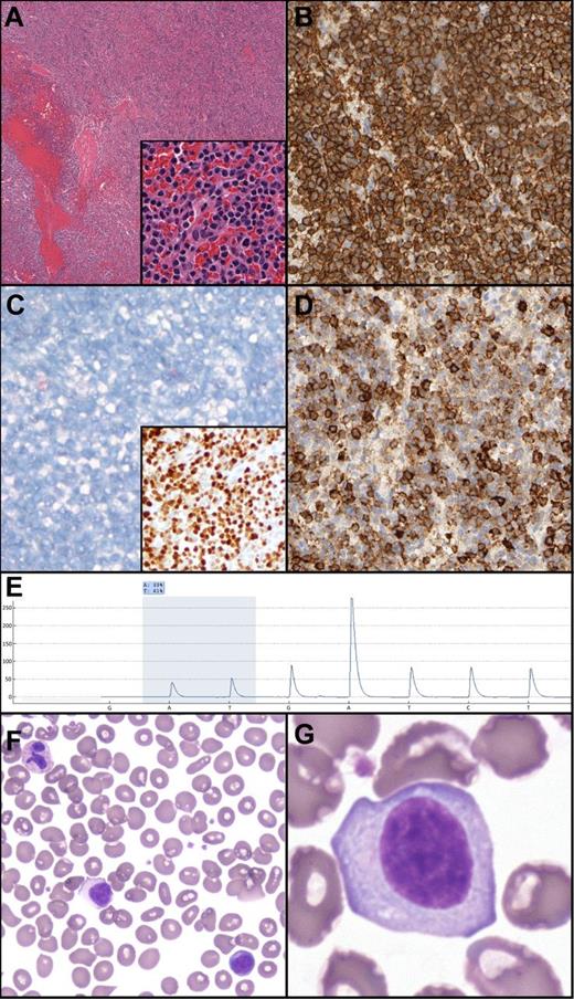 Figure 1. Unclassifiable splenic B-cell lymphoma/leukemia: histologic, morphologic, immunohistochemical and genetic features. (A) Hematoxylin and eosin demonstrates a diffuse splenic infiltrate of small mature lymphocytes, atrophic/absent white pulp, and occasional blood lakes. The infiltrate is composed of mature lymphocytes (inset). (B) CD20 expression in the neoplastic lymphocytes. (C) Absence of Annexin 1 (main panel) and positive p-ERK (inset) in the neoplastic B cells. (D) Subset DBA.44 expression in neoplastic B cells. (E) Pyrogram demonstrating the BRAF c.1799T>A mutation (shaded area; percentage indicates relative abundance). Nucleotide dispensation order is indicated along the x-axis. (F-G) Peripheral blood smear demonstrating atypical lymphocytes with abundant cytoplasm, absent villous cytoplasmic extensions, and inconspicuous nucleoli.