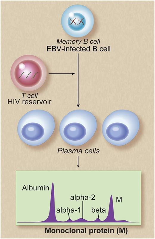 Potential mechanisms of persistent monoclonal gammopathy in patients with chronic HIV infection. Memory B cells are reservoirs of EBV infection. Poor control of HIV viral replication may result in polyclonal B-cell activation, possibly as a result of T-cell deficiency caused by HIV infection. This in turn may lead to persistent EBV replication and terminal differentiation of EBV-infected memory B cells to plasma cells. This is reflected as persistent monoclonal gammopathy, detectable in the peripheral blood. Alternative explanations may be that the EBV-infected memory B cells may act as stimulators of plasma cells or that the observed increased numbers of EBV-infected memory B cells and increased numbers of plasma cells may be independent of one another. Future functional studies are needed to better characterize mechanisms leading to persistent monoclonal gammopathy in HIV-infected patients. Professional illustration by Debra T. Dartez.
