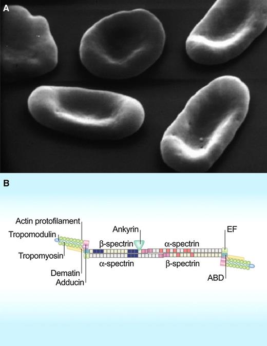 Scanning electron micrographs of red cells in hereditary elliptocytosis (A). Lateral linkages between spectrin dimer-dimers and between spectrin, actin, and protein 4.1R in the junctional complex in the spectrin-based red cell membrane skeleton (B). ABD, actin-binding domain; EF, hand motif. (Modified from Mohandas N, Gallagher PG. Blood. 2008;112(10):3939-3948.)