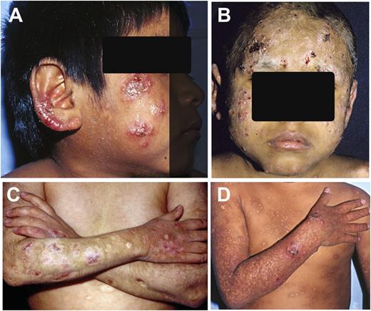 Figure 1. Skin lesions in HVLL. (A-B) Multiple skin lesions in face and ear lobes characterized by vesicles, erythema, and crusts. (C-D) In some cases, the lesions produce extensive tissue loss and disfigurement (C) and/or vacciniforme scars (D) in sun-exposed areas.