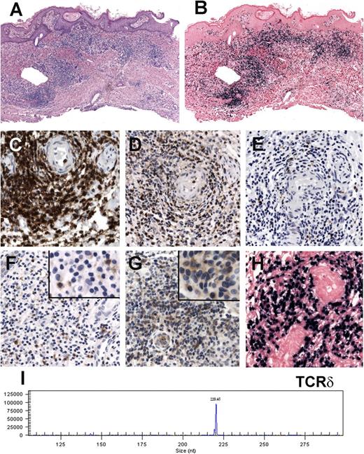 Figure 3. Immunohistochemical analysis, EBER ISH, and molecular analysis in a case with γδ T-cell phenotype (case 6). (A) Skin biopsy showing a dense lymphoid infiltrate in the dermis surrounding blood vessels and adnexae (hematoxylin and eosin stain, original magnification ×100). (B) EBER ISH reveals that practically all lymphoid cells are EBER positive (original magnification ×100). (C-G) The cells are CD3 (C) and TIA-1 positive (D) but negative for CD8 (E) and β F1 (F). Note that the lymphoid cells are TCR-γ positive (G) (C-G: immunoperoxidase, original magnification ×400). (Inset F-G: immunoperoxidase, original magnification ×630). (H) Higher magnification of the EBER ISH (original magnification ×400). (I) TCR-δ gene rearrangement shows a dominant monoclonal peak of 220 base pairs.