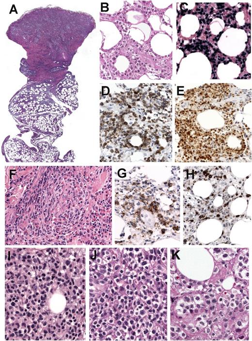 Figure 4. Immunohistochemical analysis and EBER ISH in a case with NK-cell phenotype (case 15). (A) Hematoxylin and eosin (H&E) stain of a skin biopsy with a dense infiltrate extending from the upper dermis deep into the subcutaneous tissue (original magnification ×12.5). (B-E) Higher magnification shows atypical lymphoid cells with rimming of individual fat cells mimicking subcutaneous panniculitis-like T-cell lymphoma (B). The cells are EBER positive (C), strongly and homogeneously CD56 positive (D), and TIA-1 positive (E). (B-E: original magnification ×400). (F) Higher magnification of the dermis reveals angioinvasion with abundant eosinophils (original magnification ×400). (G) CD30 stain shows many positive cells. (H) LMP1 is positive only in a few scattered cells (G-H: immunohistochemistry, original magnification ×400). (I-K) Comparative morphology of 3 skin biopsies in case 15. (I) Skin biopsy at diagnosis shows a lymphoid infiltrate of rather small lymphocytes without atypia. (J) Skin biopsy 1 year after diagnosis shows a lymphoid infiltrate composed of medium-sized cells with abundant clear cytoplasm. (K) Skin biopsy 7 years after the original diagnosis with rather atypical large cells, abundant clear cytoplasm, and prominent nucleoli (I-K: H&E stain, original magnification ×400).