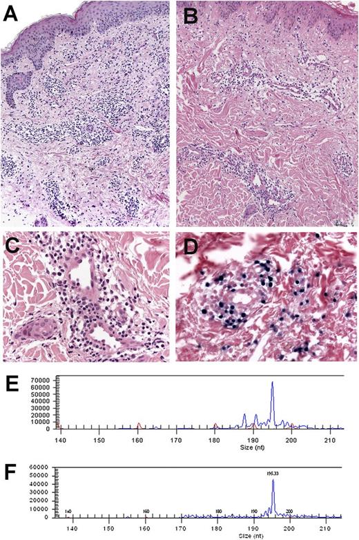 Figure 5. Morphology and comparative TCR-γ clonality analysis in case 4. (A-B) Hematoxylin and eosin stain in 2 recurrent skin biopsies taken 4 years apart at the age of 20 and 24 years. Note that the first biopsy (A) shows a denser lymphoid infiltrate when compared with the second biopsy (B; A-B: original magnification ×100). (C) Higher magnification of the second biopsy reveals a discrete infiltrate surrounding blood vessels with bland morphology. (D) Some of the lymphoid cells are EBER positive (C-D: original magnification ×400). (E-F) Amplification of the CD3 region of the TCR-γ chain gene showed an identical monoclonal peak of 195 base pairs in both biopsies.