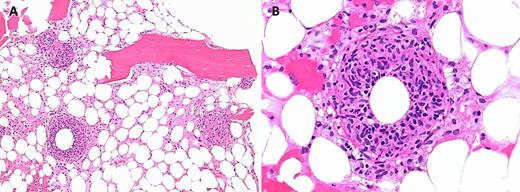 A 54-year-old man with a history of multiple myeloma presented with intermittent fevers, chills, fatigue, and weight loss for 1 month. A complete blood count showed leukopenia (white blood count: 1.4 × 109/L), mild anemia (hemoglobin: 12.4 g/dL), and thrombocytopenia (platelets: 100 × 109/L). Further testing revealed mildly elevated liver enzymes and splenomegaly. Of note, he had recently traveled throughout the southwestern United States, including Texas, for dove hunting on cattle ranches. The bone marrow biopsy revealed hypocellular marrow with panhypoplasia and multiple “doughnut” granulomas consisting of a central lipid vacuole surrounded by epithelioid histiocytes and a dense eosinophilic fibrin ring (panels A-B). Gomori-methenamine-silver and acid-fast-bacillus stains were negative on the biopsy. Serologic testing for fungal, HIV, cytomegalovirus (CMV), Treponema, and Brucella infections was negative. However, Coxiella burnetii serology testing by immunofluorescence assay showed phase 1 and 2 IgM titers >1:1024. / Q fever is an infection caused by the gram-negative intracellular bacterium C burnetii, which commonly results from the inhalation of aerosols that originate in infected birth products of domestic livestock and pets. Doughnut granulomas are highly evocative of Coxiella infections; however, they are not specific to Coxiella infections and have been seen in CMV, Epstein-Barr virus, Brucella and Salmonella infections, leishmaniasis, Hodgkin and non-Hodgkin lymphomas, and immune disorders.