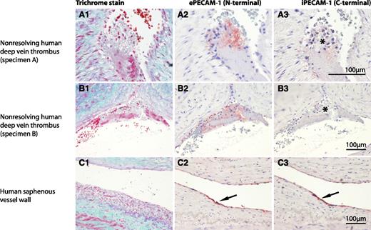 Figure 5. Differential domain-specific antibody immunoreactivities suggesting PECAM-1 cell surface shedding at the site of thrombosis. The left side of the panel shows trichrome stains of 2 cases of nonresolving human deep vein thrombus (specimen A-B, A1, and B1) and the vessel wall from a human saphenous vein (C1). These tissue samples were immunhistochemically stained using domain-specific antibodies directed against the extracellular domain (N-terminal) of PECAM-1 (ePECAM-1: A2, B2, and C2) and intracellular portion (C-terminal) of PECAM-1 (iPECAM-1: A3, B3, and C3). Cleaved PECAM-1 is characterized by the presence of immunoreactivity derived from the antibody against ePECAM-1 in the absence of immunoreactivity derived from the antibody against iPECAM-1. The area of discordant PECAM-1 expression (A2 vs A3; B2 vs B3) is highlighted with an asterisk (A3, B3). By contrast, the endothelial cell layer of saphenous vein wall stains positively with both antibodies, indicating full length PECAM-1 expression (C2-3, arrows). Scale bar, 100 μm.