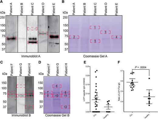 Figure 2. Autoreactive membrane associated proteins were identified in a subset of eight CLL patients. (A-D) Immunoblot analysis of autoreactive membrane associated proteins demonstrated immunoreactive bands (delineated by red boxes) (A,C). The identified autoreactive bands were subsequently excised from the coomassie-stained twin gels (B,D) and analyzed by mass spectroscopy to obtain preliminary protein identifications (Table 1). (E) ELISA analysis of LCP1-specific IgG in 33 previously untreated CLL patients and 6 healthy donor controls. (F) ELISA was used to compare autoimmune IgG responsiveness to LCP1 relative to the known vaccine antigen, tetanus toxin (Tet). All CLL patients assayed by ELISA had not received any previous intravenous immunoglobulin therapy. Statistical analysis was performed by Student t test; Error bars indicate standard error of the mean (P = .0004).