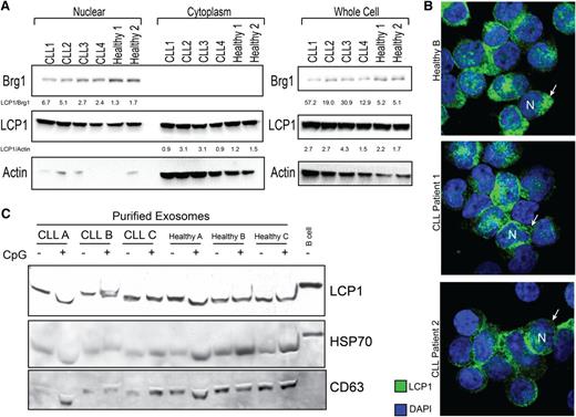 Figure 3. LCP1 protein was identified in the nucleus, cytoplasm, and exosomes of both CLL cells and healthy B cells. (A) Immunoblot analysis of whole cell, nuclear, and cytoplasmic extracts demonstrates that LCP1 protein is present in both subcellular compartments in healthy donor and CLL B cells. Brg1 protein is used as a nuclear loading control, and β-actin is used as a cytoplasmic loading control. Quantitative analysis of band density relative to Actin or Brg1 controls is provided. (B) Confocal immunofluorescent analysis of LCP1 localization in CLL cells and healthy donor B cells confirms evidence that LCP1 is heavily represented in both the nuclear (N) and cytoplasmic (arrow) compartments of malignant and healthy B lymphocytes. (C) Purified exosomes isolated from ex-vivo cultured CLL cells or healthy B cells with or without CpG stimulation were probed for LCP1 by immunoblot. CD63 and HSP70 were used as exosome-specific loading controls.