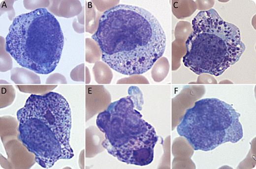 A 59-year-old woman with disseminated intravascular coagulation was transferred after a dose of growth factor for “leukopenia.” Laboratory studies showed elevated d-dimer (201 934 ng/mL), with a white blood cell count of 41 000/mm3 (blasts, 19%; promyelocytes, 37%) and platelets of 49 000/μL, at which time all-trans-retinoic acid (ATRA) had already been instituted owing to a high suspicion of acute promyelocytic leukemia (APL). In the peripheral blood smear, a proportion of promyelocytes appeared overtly leukemic (with deeply clefted nuclei), and others appeared nonleukemic (with paranuclear Hof and toxic changes). Notably, several promyelocytes contained numerous immature pink azurophilic granules (panel A). These granules formed small clumps with cytoplasmic clearing (panels B-C) or existed as larger, globular pink structures with Chediak-Higashi–like morphology (panels D-E). Panel F shows a bilobed (coin-on-coin) promyelocyte with finely granular cytoplasm. Flow cytometry identified a CD34−/HLA-DR− myeloid population, whereas fluorescence in situ hybridization confirmed the presence of t(15;17). / Chediak-Higashi–like granules are rarely observed in APL. Ultrastructurally, they represent aggregates of immature primary (azurophil) granules that show a crystalline structure and/or vacuolization—a feature lacking in Chediak-Higashi disease. Their occurrence in this case helped confirm a leukemic phenotype amid a confounding growth factor effect and concurrent ATRA therapy before ancillary studies were available.
