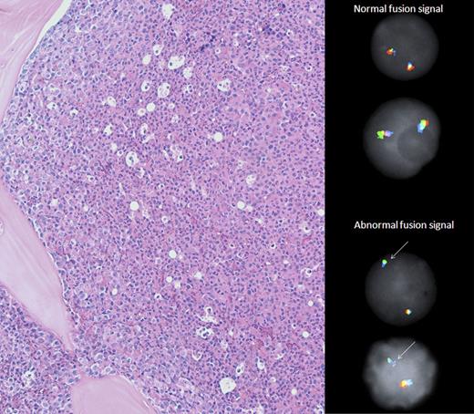 Figure 1. Bone marrow morphology and CHIC2 FISH. The bone marrow biopsy (left panel) demonstrated hypercellularity and marked predominance of maturing neutrophilic granulocytes. Megakaryocytes were decreased, and no features of myelofibrosis or myelodysplasia were present. Notably, eosinophils and blasts were rare. By fluorescence in situ hybridization (right panel) using a tricolor probe set (Abbott Molecular), normal cells had two intact tricolor (green/orange/aqua) fusion signals whereas abnormal cells (90% in this sample) with monoallelic loss of CHIC2 (orange pseudocolor) had one green/aqua fusion signal.