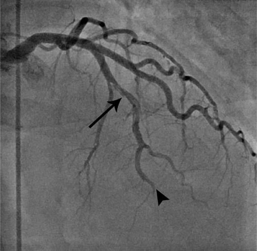 Figure 1. Coronary angiogram. Right anterior oblique cranial projection outlining the typical angiographic appearance of coronary artery dissection of the mid segment of the left anterior descending artery (arrow). Furthermore, it reveals an abrupt cutoff of the distal left anterior descending artery consistent with thrombotic occlusion (arrowhead).
