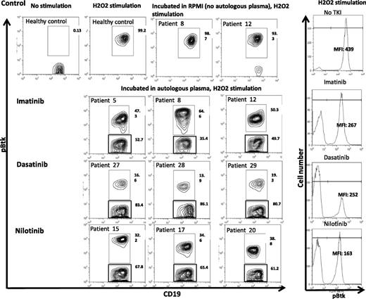 Figure 4. Inhibition of Btk phosphorylation in CD19+ B cells from CML patients on TKI coincubated with autologous plasma. Cryopreserved PBMCs from CML patients on TKI (imatinib, n = 3; nilotinib, n = 3; and dasatinib, n = 3) were thawed, washed, and cocultured with autologous plasma or RPMI/10% fetal calf serum overnight. PBMCs were then stimulated with 5 mL of 50 mM of H2O2 for 15 minutes at 37°C. The stimulation was terminated by the addition of 5 mL prewarmed Cytofix Buffer (BD Biosciences, San Jose, CA) at 37°C for 12 minutes. Cells were fixed/permeabilized and stained with pBtk-PE (BD Biosciences) and APC-conjugated anti-CD19 (BD Biosciences). Data acquisition was performed on the FACSCalibur, and FlowJo software was used for analysis. MFI of Btk phosphorylation following incubation with autologous plasma in gated CD19+ B cells from representative CML patients on imatinib, dasatinib, or nilotinib is presented (right panel).