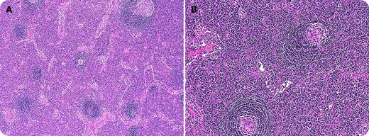 A 48-year-old woman presented with a 2-week history of peripheral neuropathy. She progressively developed motor weakness leading to quadriparesis and respiratory failure requiring intubation. Nerve conduction studies showed diffuse absence of motor and sensory responses. She had a right cervical mass that was excised, which showed regressed follicles with expansion of interfollicular region by sheets of plasma cells. The majority of the follicles contained lymphocyte-depleted germinal center surrounded by a broad mantle zone with an “onion skin” pattern (panel A); some follicles were penetrated by hyalinized blood vessels (panel B). The bone marrow biopsy showed thickened trabeculae and increased atypical megakaryocytes. The overall features were suggestive of Castleman disease, plasma cell variant. Serum immunofixation showed monoclonal IgG λ (M-spike, 0.8 g/dL); vascular endothelial growth factor level was elevated at 1101 pg/mL. A diagnosis of POEMS (polyneuropathy, organomegaly, endocrinopathy, monoclonal gammopathy and skin changes) syndrome was made. She was treated with cyclophosphamide and dexamethasone. With four cycles of treatment, she regained upper extremity strength and is now ventilator independent. / POEMS syndrome is a rare paraneoplastic syndrome resulting from an underlying plasma cell disorder. The diagnosis is often delayed because of incorrect diagnoses of chronic inflammatory demyelinating polyradiculoneuropathy and monoclonal gammopathy of undetermined significance. Between 11% and 30% of patients with POEMS have documented Castleman disease or Castleman-like histology. Prompt treatment directed at the plasma cell clone produces good responses in majority of the patients.