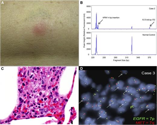 Figure 1. Clinical and pathological manifestations of neutrophilic dermatoses. (A) Photograph of the erythematous, tender nodule on the outer right thigh of patient 2, arising 6 weeks after initiation of the FLT3 inhibitor quizartinib. (B) Fragment size analysis for FLT3 ITD and NPM1 insertion mutations. A representative analysis for FLT3 ITD and NPM1 insertion mutations using a PCR fragment size assay targeting FLT3 exon 15 and NPM1 exon 12 in genomic DNA extracted from the skin biopsy sample from patient 2. Arrows indicate the respective insertion mutations found in the patient but not in the normal control. (C) Histology of skin biopsy from patient 3. Clusters of neutrophils are present within subcutaneous fat, admixed with histiocytes. No blasts are identified (original magnification 1000×, images taken on Olympus BX41 microscope). (D) EGFR (7p) and MET (7q) FISH. Copy number analysis by FISH was performed on a skin biopsy formalin-fixed paraffin-embedded tissue section from patient 3, using probes specific for EGFR (green), which corresponds to chromosome 7p, and MET (red), which corresponds to chromosome 7q. The arrows indicate nuclei showing a single copy loss of MET or 7q, identified within the subcutaneous neutrophilic infiltrates.