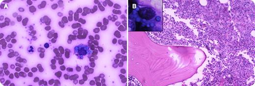 A 58-year-old white female had severe bone pain for 1 week. Increased levels of free λ light chain (2423 mg/L) were present in the serum with decreased levels of all immunoglobulins. The complete blood count and differential were within normal limits. The peripheral blood smear had increased rouleaux formation and atypical plasma cells containing numerous cytoplasmic Russell bodies (panel A). There were no lytic lesions on skeletal survey or positron emission tomography–computed tomography scan, and organmegaly or lymphadenopathy were not detected. Bone marrow biopsy was hypercellular with an extensive infiltrate of atypical plasma cells containing numerous small intracytoplasmic globules (Russell bodies); larger extracellular globules were also present (panel B). The marrow smear showed multiple blue intracytoplasmic Russell bodies, resembling a bunch of grapes, referred to as Mott or morula cells (panel B inset). / Flow cytometry and immunohistochemistry confirmed the λ light chain restriction in plasma cells. In addition, there was osteosclerosis in the bony trabeculae. A remarkable feature of the present case was the abundance of Russell bodies in the marrow as well as circulating plasma cells in a patient with λ light chain osteosclerotic myeloma.