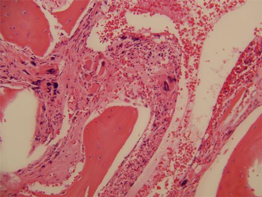 Figure 1. Initial bone marrow biopsy, hematoxylin and eosin stain.