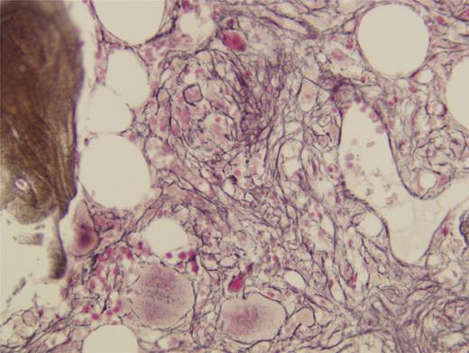 Figure 2. Initial bone marrow biopsy, reticulum stain.