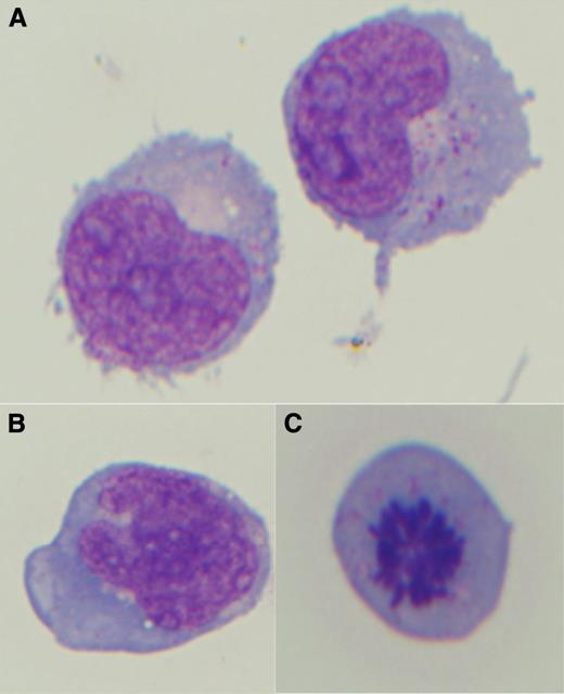 Figure 1. CSF cytology shows atypical reactive monocytic cells. (A) Morphologic features show delicate nuclear chromatin, multiple prominent nucleoli, and moderate gray-blue cytoplasm with azurophilic granules. (B) Some reactive monocytes show delicate-lacey chromatin with more irregular nuclear contours. (C) Occasional mitosis is present.