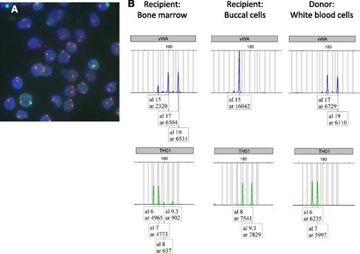 Figure 1. Donor origin of leukemia demonstrated by 2 different molecular methods. (A) Fluorescence in situ hybridization examination of the bone marrow demonstrating 85% of the cells to exhibit a XX chromosomal pattern (2 red signals per nucleus), all of them were morphologic with immature aspect, suggesting the leukemic cells of donor origin. Note the few residual cells of the recipient with XY chromosomal pattern (1 red and 1 green signal per nucleus). FISH was performed using the directly labeled, dual-color (red/green) X- and Y-chromosome probe mix (Xp11.1-q11.1/Yq12) Z-2016 (ZytoVision, Bremerhaven, Germany). The sections were processed with a paraffin pretreatment reagent kit (Abbott/Vysis, Baar, Switzerland), and hybridization was performed according to the manufacturer’s specifications. Denaturation was conducted for 10 minutes at 73°C, and the FISH probes were incubated overnight at 37°C in Hybrite (Abott/Vysis). Counterstaining was performed with 4,6-diamidino-2-phenylindole. The FISH signals were visualized on a Olympus BX43 fluorescence microscope equipped with double bandpass filters for simultaneous visualization of green and red signals. (B) Short tandem repeat profile of the 2 representative chromosomal loci vWA and TH01. Left: Recipient bone marrow cells at diagnosis of AML. Middle: Recipient buccal cells. Right: Donor white blood cells, demonstrating mixed chimerism and donor origin of cells. Taking all 8 discriminative chromosomal loci and the Amelogenin system into calculation, a donor chimerism of 86% can be demonstrated. This is in perfect agreement with the >80% blast infiltration of the marrow and 85% of cells exhibiting an XX chromosomal pattern.