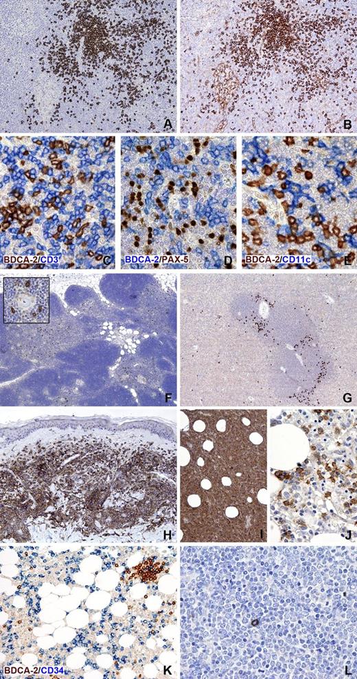 Figure 1. Immunohistochemical expression of BDCA-2 in normal lymphoid tissues and hematopoietic neoplasms. BDCA-2 immunostaining of a reactive lymph node (A) identifies aggregates and dispersed PDCs; in contrast, note that anti-CD123 applied on a serial section labels not only PDCs but also histiocytes and high endothelial venule endothelium (B). BDCA-2 is selectively expressed on PDCs and not on T-cells, B-cells, and macrophages/myeloid dendritic cells, as shown by double immunostainings, respectively, for BDCA-2 and CD3 (C), PAX-5 (D), and CD11c (E). In the thymus, BDCA-2 highlights scattered PDCs located in the medulla (F), where they frequently surround Hassall’s corpuscles (insert). In the spleen, BDCA-2-positive PDCs are particularly located at the periphery of the white pulp (G). Neoplastic PDCs show strong positivity for BDCA-2, as illustrated in representative cases of BPDCN with cutaneous (H) and bone marrow involvement (I-J). BDCA-2 can be very helpful in detecting minimal tumor cell infiltrate in the bone marrow (J).It must be noted, however, that BDCA-2 reactivity in this tissue can be variable, likely due to antigen degradation consequently from decalcification. BDCA-2 is totally negative on tumor cells in 2 representative samples of AML (K) and ALL (L), in which rare reactive PDCs are also detected. In the AML case (M2 in FAB classification) myeloid blasts are highlighted by anti-CD34. Single immunostaining for BDCA-2 was performed after heat-based antigen retrival in ethylenediaminetetraacetic acid buffer, pH 8.0; reactivity was revealed using the NovoLink Polymer kit (Leica Microsystems, Newcastle upon Tyne, United Kingdom) followed by diaminobenzidine as brown chromogen. For double immunostainings (C-E and K), the blue reaction visualizing the second antibody was obtained using the Mach 4-AP kit followed by Ferangi Blue as chromogen (Biocare Medical, Concord, CA). Images were obtained with the BX60 microscope, DP-70 digital camera, and image processing software (Olympus, Hamburg, Germany). Original magnifications, ×40 (F), ×100 (G-I), ×200 (A, B, K), and ×400 (C-E, inset in F, and J and L).