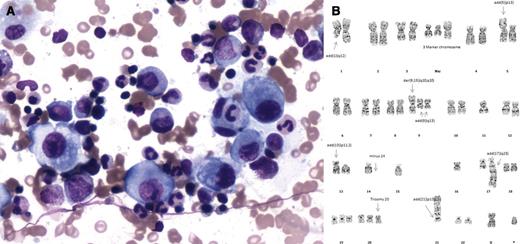 A 58-year-old man presented with backache, weight loss, and fever for 1 month. Laboratory tests showed a hemoglobin of 9.9 g/dL, white cell count of 31.1 × 109/L, neutrophil count of 26.9 × 109/L, platelet count of 46 × 109/L, serum ferritin of 1096 µg/L, fasting triglyceride of 1.04 mmol/L, and fibrinogen level of 6.40 g/L. Viral studies, as well as cultures of blood, urine, and sputum, were all negative. A computer tomography scan detected pathological fractures of the ribs. A bone scan demonstrated abnormal radiotracer foci involving the left sixth rib, vertebrae, and left ilium. The bone marrow aspirate showed atypical mononuclear cells and a few hemophagocytes (8% of all nucleated cells; panel A), reduced megakaryopoiesis, and no evidence of dysplasia. Karyotyping of the marrow specimen revealed complex structural and numerical abnormalities (panel B). Computer tomography–guided biopsy of the left iliac bone lesion confirmed adenocarcinoma. The primary site of the malignancy was never identified, and he died of cancer about 1 month after the diagnosis. / The clinical features of fever, cytopenias, elevated ferritin, and hemophagocytosis in bone marrow are diagnostic of hemophagocytic syndrome, which is associated primarily with lymphoma and rarely with carcinoma. A complex karyotype is rarely reported in metastatic carcinoma because karyotyping is not routinely done in this setting, and thus the significance of this finding is uncertain.