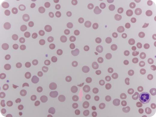 A 23-year-old white woman with a history of intravenous drug abuse presented to the emergency department with decreased level of consciousness, chest discomfort, and shortness of breath. Blood work showed anemia (hemoglobin, 7.6 g/dL), thrombocytopenia (platelet count, 69 000/μL), and evidence of hemolysis as reflected by elevated lactate dehydrogenase, undetectable haptoglobin, and brisk reticulocyte response. Iron indices, B12, and folate were within normal limits. A peripheral smear indicated microangiopathic hemolysis with red blood cell fragmentation (schistocytes and helmet cells, arrow). The patient had been abusing Opana ER 30 mg tablets by crushing and self-injecting up to 8 times daily. She was started on plasma exchange for a thrombotic thrombocytopenic purpura–like syndrome, and her hematological parameters normalized after 1 week of therapy. No evidence of concomitant infection was found. Interestingly the patient maintained normal creatinine and a disintegrin and metalloproteinase with thrombospondin motif 13 (ADAMTS13) activity. / The patient was counseled on the risk of blood-borne infections associated with intravenous drug abuse. This association has recently been reported by clinicians at the Tennessee Department of Health and was published in January 2013 by Marder et al in the Mortality and Morbidity Weekly Report by the Centers for Disease Control. Thus, identifying and screening for intravenous abuse with Opana ER in patients who present with TTP-like syndrome is recommended.