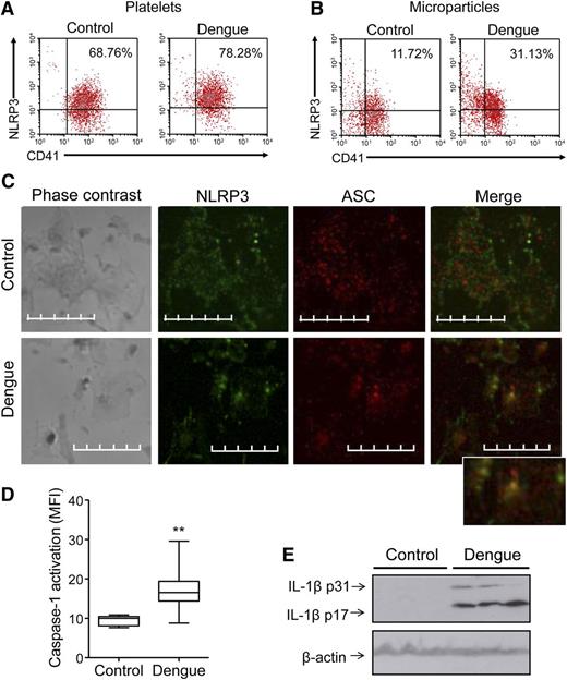 Figure 3. Activation of the NLRP3 inflammasome in platelets from DV-infected patients. (A-B) Representative density plots showing the expression of NLRP3 in (A) platelets and (B) MPs from healthy subjects (control) or patients with dengue (dengue). The values in each region of the quadrants indicate the cell frequencies in the respective quadrant. (C) Platelets obtained from healthy subjects and patients with dengue were stained with anti-NLRP3 (green) and anti-ASC (red) and examined by confocal microscopy using an Olympus FV10i-O with a 240× lens. The images were processed using FLUOVIEW FV1000 MPE software version 5.0 and further analyzed using Adobe Photoshop CS Version 8.0. Bars represent 10 µm. (D) Caspase-1 activation in platelets isolated from control participants and dengue patients was assessed by the MFI of the fluorescent probe FLICA. The boxes indicate the median and interquartile ranges and the whiskers indicate 5 to 95 percentile. **P < .01 compared with healthy volunteers. (E) Western blot analysis of pro (p31) and cleaved (p17) IL-1β and of β-actin in platelets that were isolated from 3 healthy volunteers and 3 dengue patients.